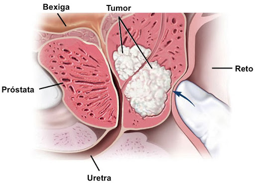 Câncer de Próstata O Que Você Precisa Saber